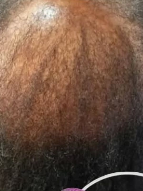 Before — Scalp restoration results